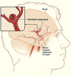 cerebral aneurysm clipping
