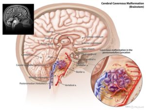 brain stem cavernoma